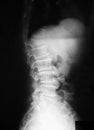 X-ray image of T-L spine, lateral view.