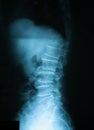 X-ray image of T-L spine, lateral view. Showing a compression fracture at T12