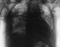 X-ray image of thoracic organs of patient