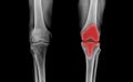 TKA knee joint x-ray Royalty Free Stock Photo