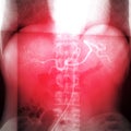 X-ray image of TOCE or Transcatheter Oily Chemo Embolization .