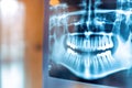 X-ray image of a tooth showing a gap where a tooth is missing, useful for medical or dental contexts Royalty Free Stock Photo