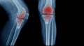 TKA knee joint x-ray Royalty Free Stock Photo