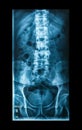 X-Ray image, View of backbone men for medical diagnosis. Royalty Free Stock Photo