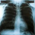 X-Ray image, View of chest men for medical diagnosis. Royalty Free Stock Photo