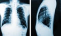X-Ray image, View of chest men for medical diagnosis. Royalty Free Stock Photo
