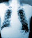 X-Ray image, View of chest men for medical diagnosis. Royalty Free Stock Photo