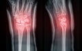 The X-ray image vividly displays a wrist joint fracture, offering a clear visual representation for medical diagnosis and