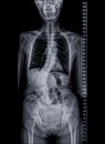 X-ray image of Whole Spine for diagnosis scoliosis of spine
