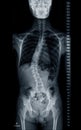 X-ray image of Whole Spine for diagnosis scoliosis of spine