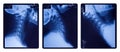 X-ray images of the neck spine Royalty Free Stock Photo