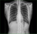 X-ray images chest lung