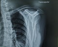 X-ray images of the shoulder and clavicle joint to view tendon and bone injuries for medical diagnosis.