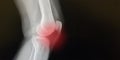 X-Ray of an inflamed knee joint in black, white and red