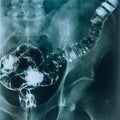 X-ray of the intestine. Radiological examination of a diseased intestine.