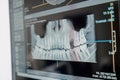 X-ray of the jaw with teeth on a computer monitor. Examination of the oral cavity using digital, medical equipment Royalty Free Stock Photo