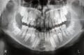 X-ray of jaw with teeth and mi