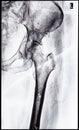 x-ray of junction of tibia and pelvis after healed