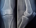 X-ray of a knee Royalty Free Stock Photo