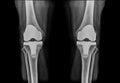 X-ray knee athoplasty Royalty Free Stock Photo