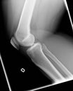 X-ray of knee with Chondromalacia Royalty Free Stock Photo