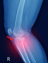 X-ray knee Fracture proximal metaphysis of tibia.Depressed fracture of lateral tibial plateau.severe swelling of soft tissue on Royalty Free Stock Photo