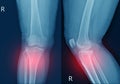 X-ray knee Fracture proximal metaphysis of tibia.Depressed fracture of lateral tibial plateau.severe swelling of soft tissue on Royalty Free Stock Photo