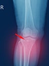 X-ray knee Fracture proximal metaphysis of tibia.Depressed fracture of lateral tibial plateau.severe swelling of soft tissue on Royalty Free Stock Photo