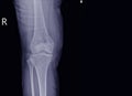 X-ray Knee join a female 15 year old Showing large osteolytic lesuion of medial aspect of right distal femur.with soft tissure Royalty Free Stock Photo