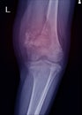 X-ray Knee join Showing large osteolytic lesuion of medial aspect of left distal femur.with soft tissure mass.and malignant bone t Royalty Free Stock Photo