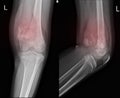 X-ray Knee join Showing large osteolytic lesuion of medial aspect of left distal femur.with soft tissure mass.and malignant bone t