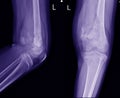 X-ray Knee join Showing large osteolytic lesuion of medial aspect of left distal femur.with soft tissure mass.and malignant bone t