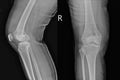 X-ray knee joint AP,LATERALViews showing Osteosarcoma Royalty Free Stock Photo