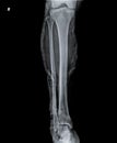X ray of Knee joint with femur, tibia and fractured fibula bone.
