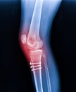 X-ray Knee Joint Fracture proximal tibia and Post fix fracture proximal tibia with plate and screws, highlighted in red Royalty Free Stock Photo