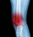 X-ray Knee Joint Fracture proximal tibia and Post fix fracture proximal tibia with plate and screws, highlighted in red Royalty Free Stock Photo