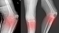 X-ray Knee Joint Fracture proximal tibia and Post fix fracture proximal tibia Royalty Free Stock Photo