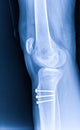 X-ray Knee Joint Fracture proximal tibia and Post fix fracture proximal tibia with plate and screws.Normal joint space.Minimal Royalty Free Stock Photo