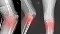 X-ray Knee Joint Fracture proximal tibia and Post fix fracture proximal tibia Royalty Free Stock Photo