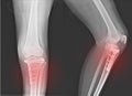 X-ray Knee Joint Fracture proximal tibia and Post fix fracture proximal tibia Royalty Free Stock Photo