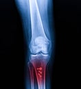 X-ray Knee Joint Fracture proximal tibia and Post fix fracture proximal tibia with plate and screws, highlighted in red Royalty Free Stock Photo