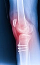 X-ray Knee Joint Fracture proximal tibia and Post fix fracture proximal tibia with plate and screws, highlighted in red Royalty Free Stock Photo