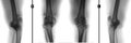 X-ray of the knee joints. Deforming arthrosis. Negative.