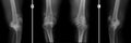 X-ray of the knee joints. Deforming arthrosis.