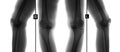 X-ray of knee joints. Deforming osteoarthritis. Negative. Royalty Free Stock Photo