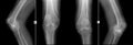 X-ray of knee joints. Deforming osteoarthritis. Negative.