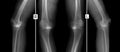 X-ray of knee joints. Deforming osteoarthritis.