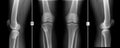 X-ray of knee joints. Giant cell tumor of the right tibial. Royalty Free Stock Photo