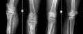 X-ray of knee joints. Osteomyelitis of the right tibial. Royalty Free Stock Photo