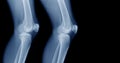 X-ray knee on black background